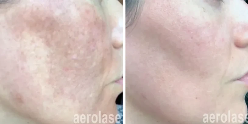Aerolase® Laser before and after result 2
