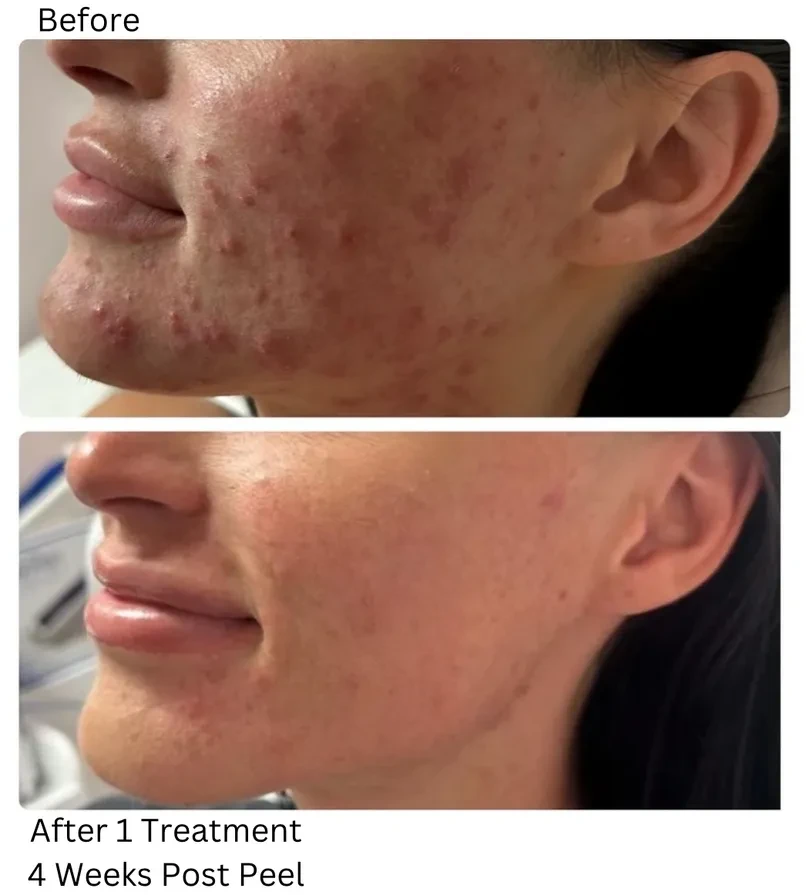 Perfect Derma™ Peel before and after result 1